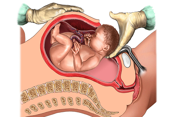 Cesarean Section Delivery